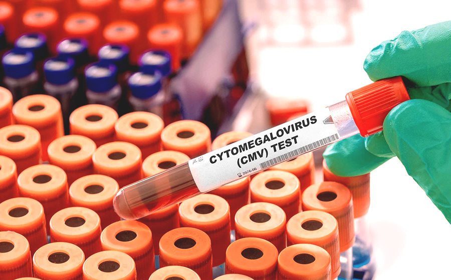 CMV po przeszczepie komórek macierzystych – test na cytomegalię