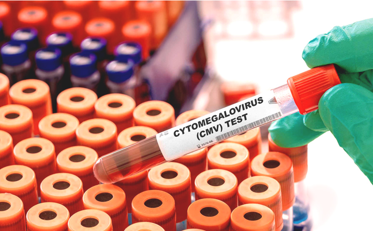 CMV diagnoza