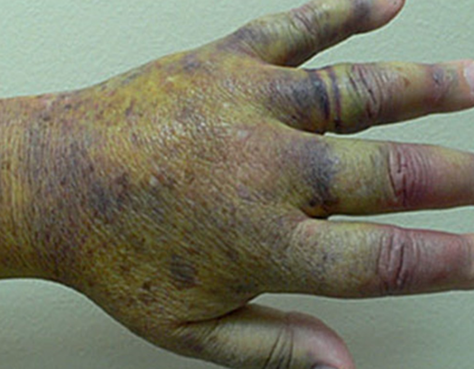 Hemofilia nabyta siniaki